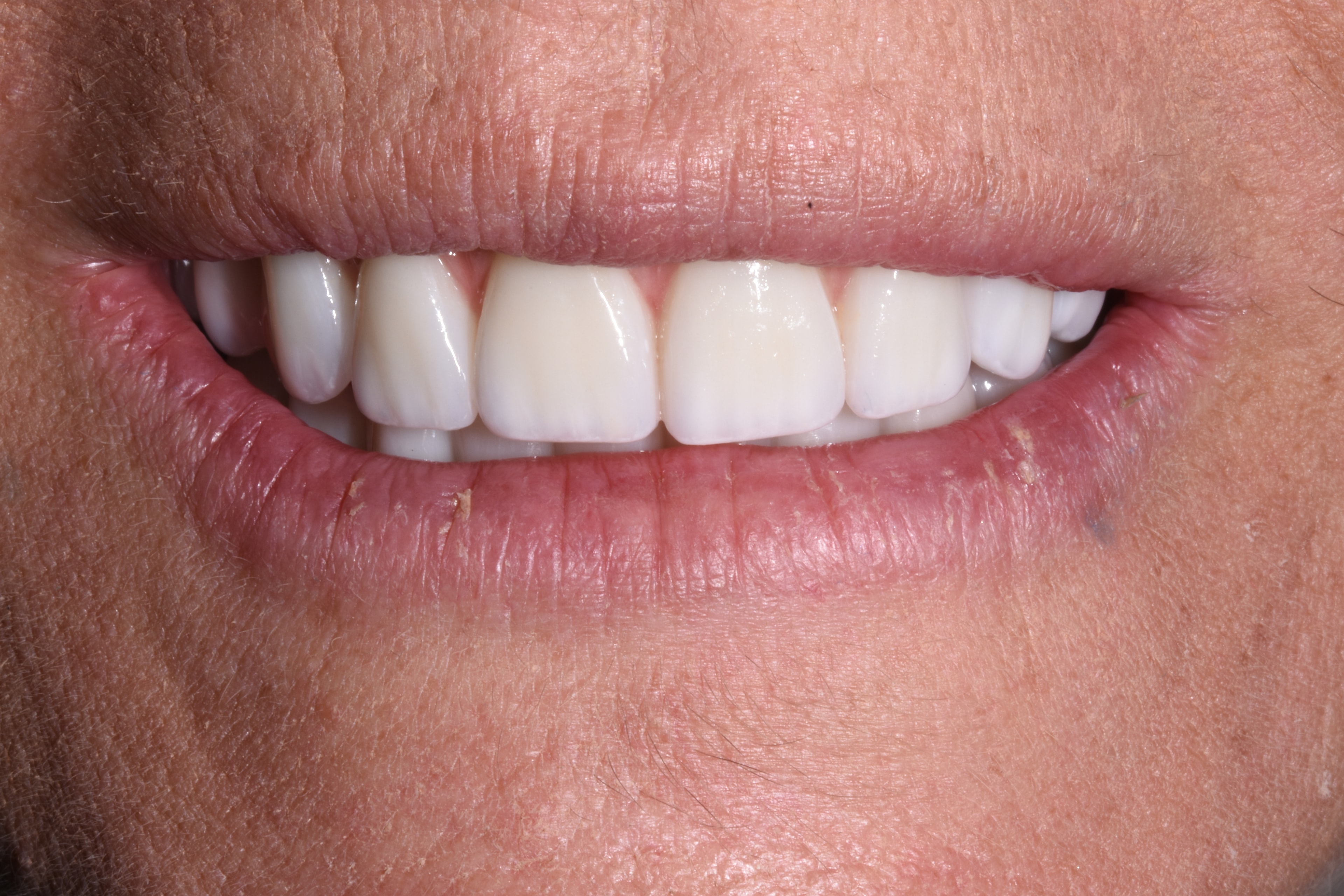 Snap-On Overdentures — after