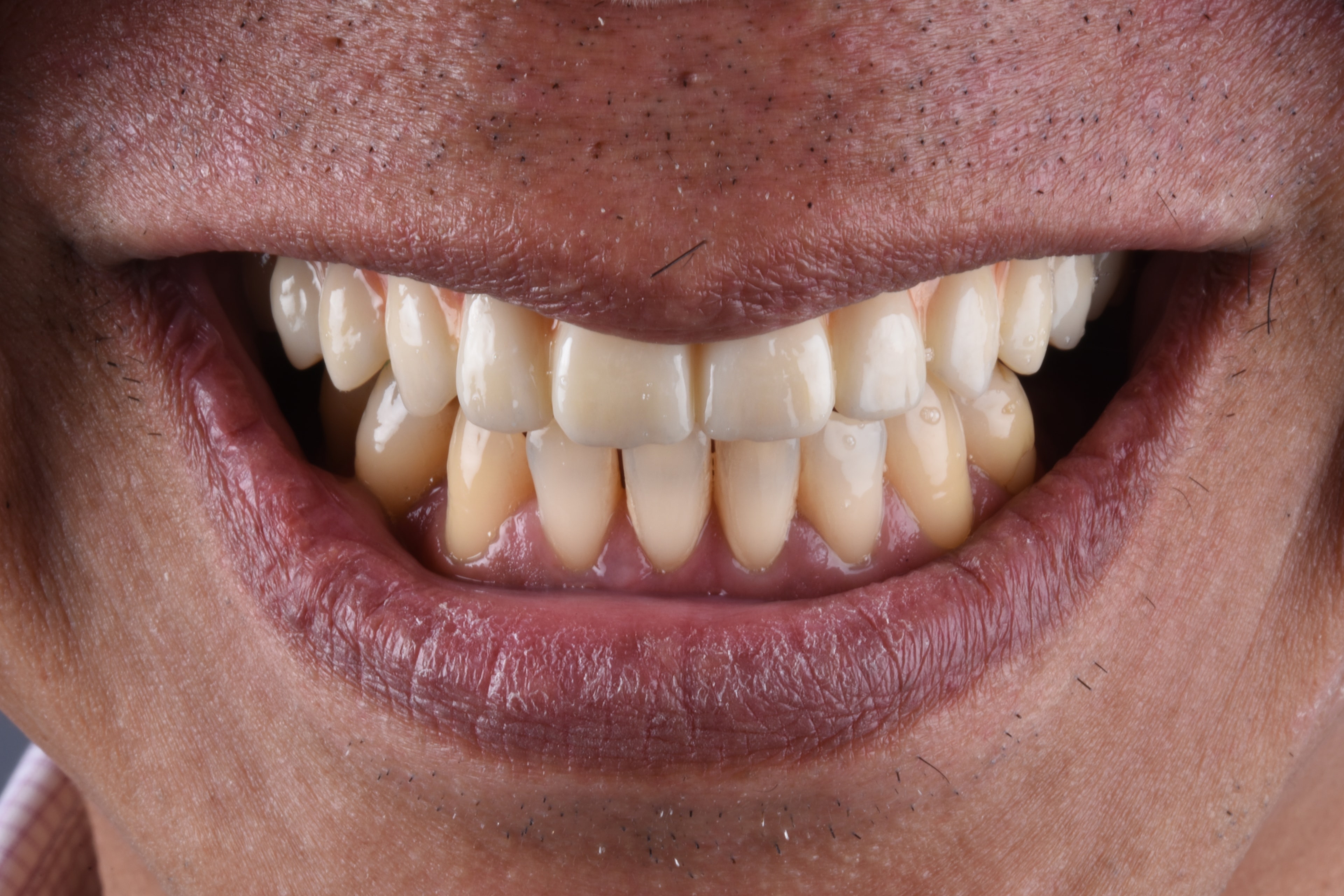 Single Implant Placement — after