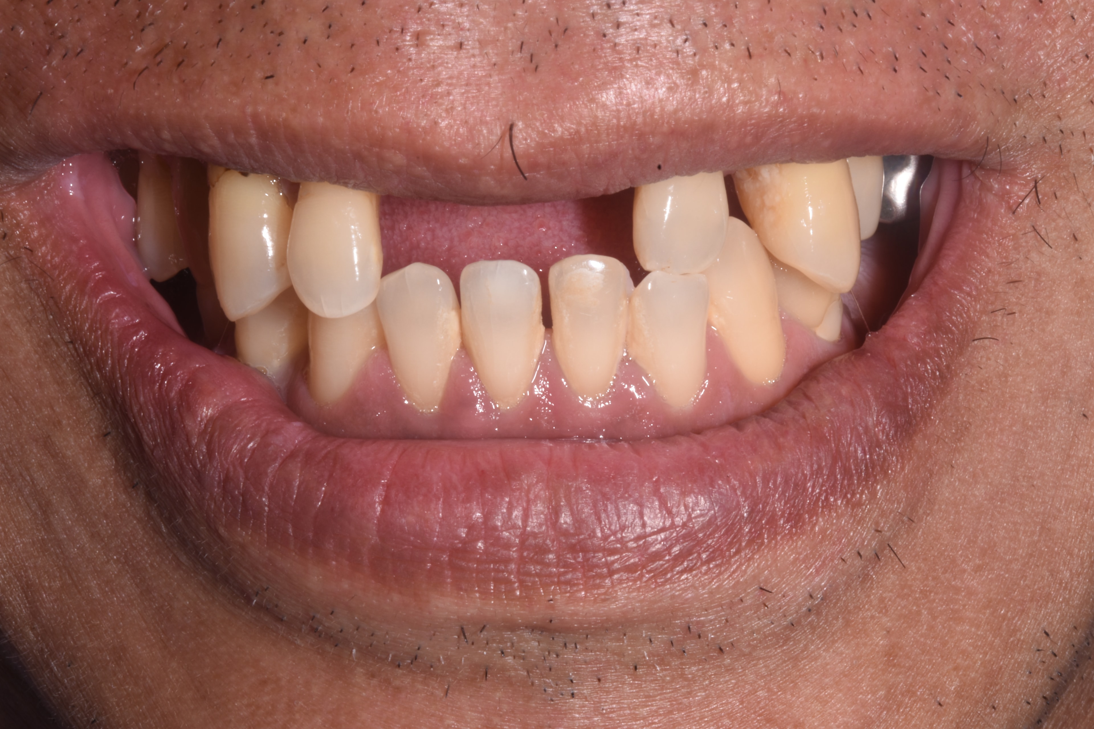 Single Implant Placement — before