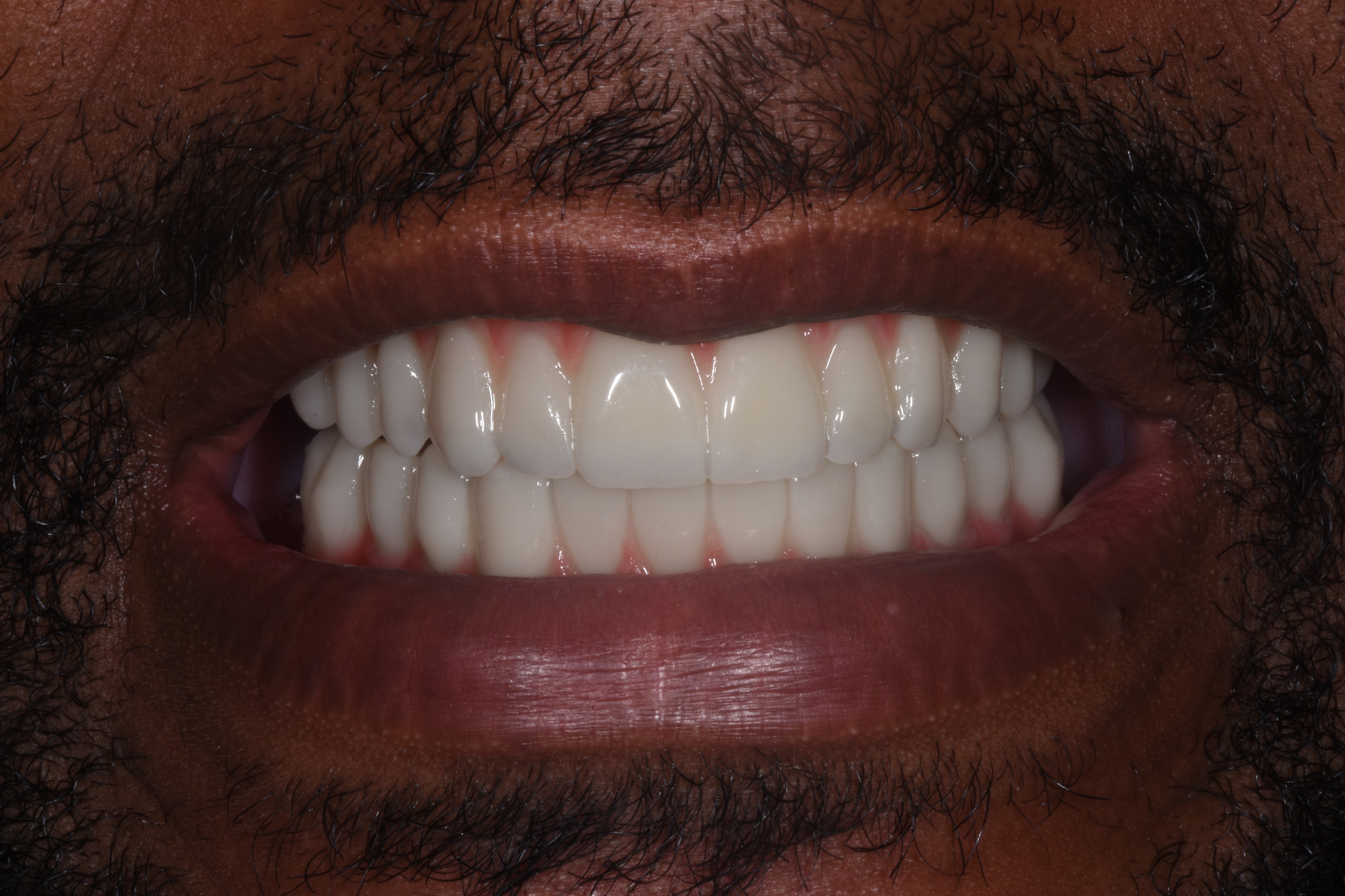 Zirconia Hybrid (Full-Arch) — after