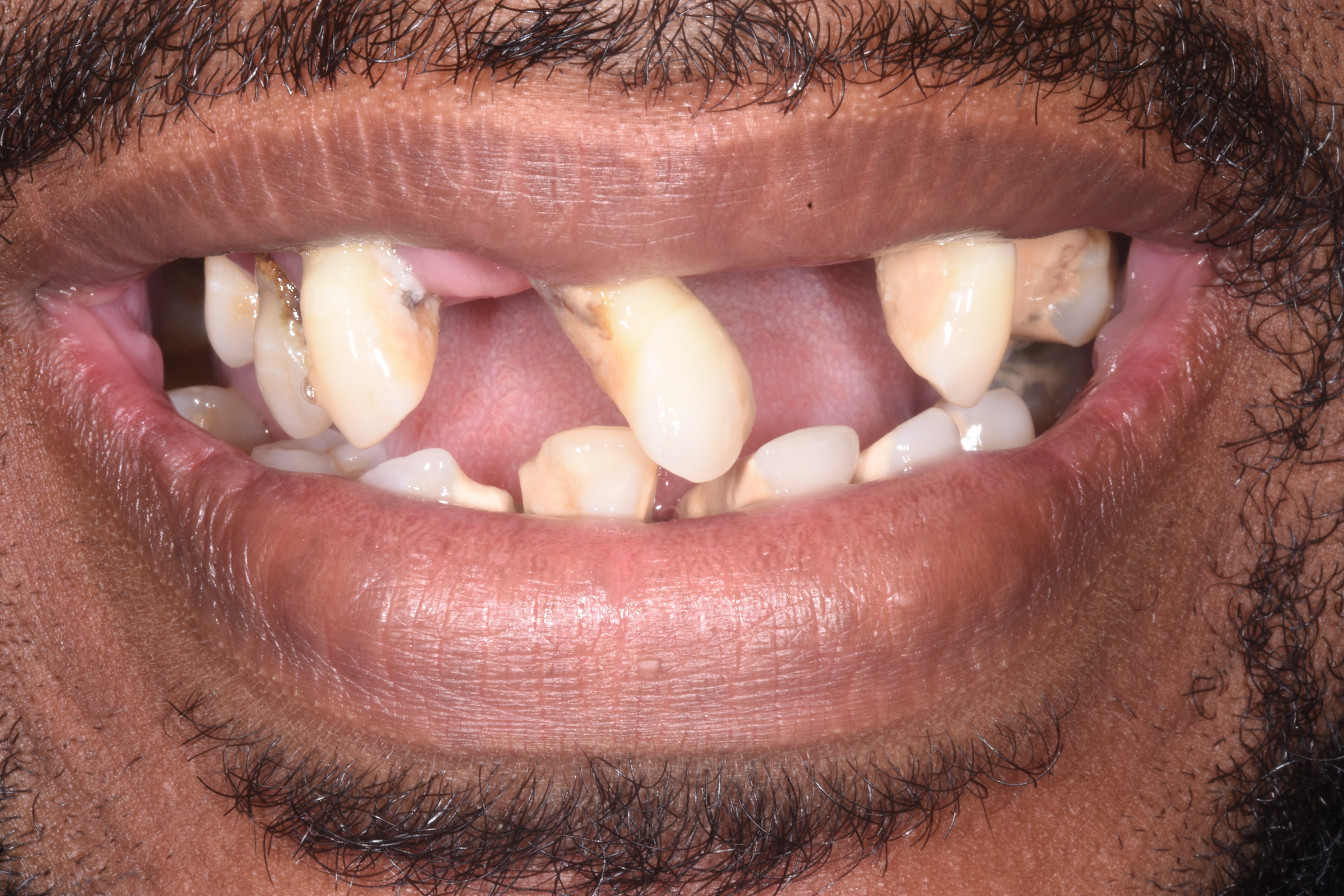 Zirconia Hybrid (Full-Arch) — before